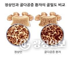 정상인과 골다공증 환자의 골밀도 비교